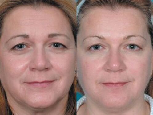 photo before and after plasma skin rejuvenation