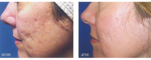 Before and after applying the laser device to the skin with scars