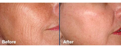 Facial skin before and after laser rejuvenation procedure