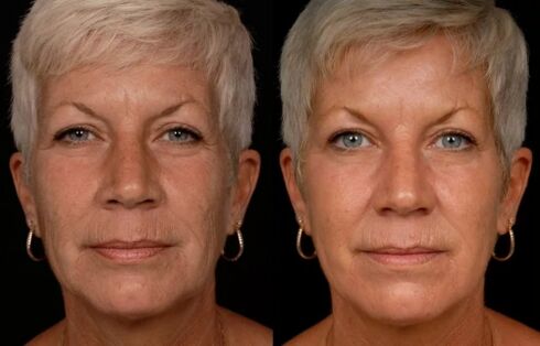 The result of laser treatment of facial skin - reduction of wrinkles